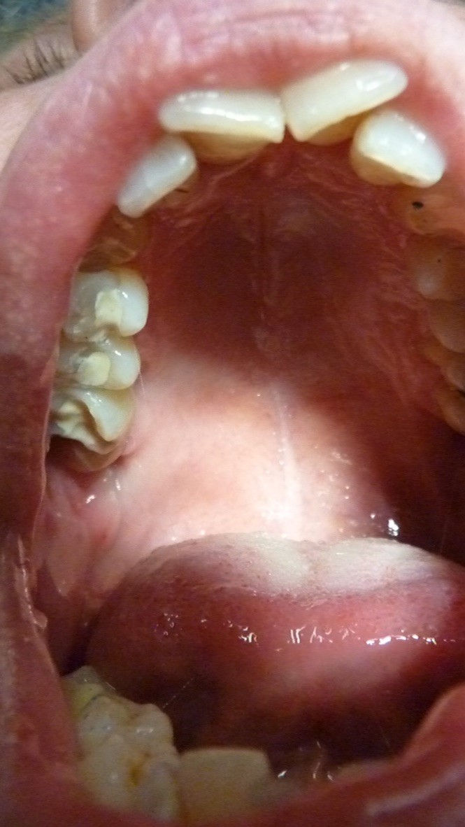 ganzheitliche Zahnheilkunde Dr. Heike Kretschmar - Zementfüllung
