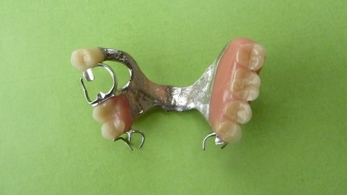 ganzheitliche Zahnheilkunde Dr. Heike Kretschmar - Zahnersatz einer herausnehmbaren Modellgussprothese