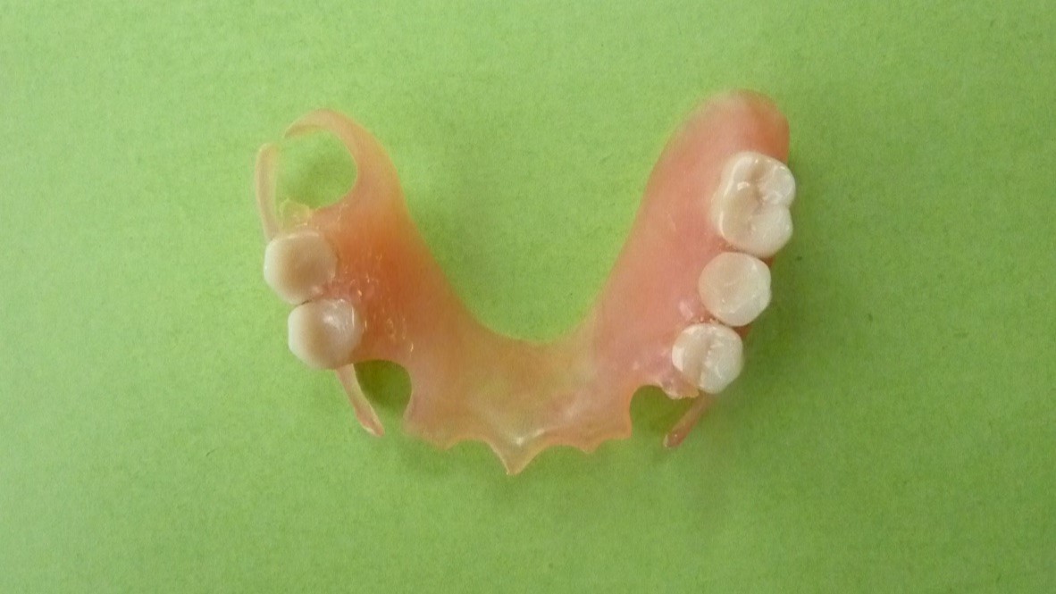 ganzheitliche Zahnheilkunde Dr. Heike Kretschmar - Zahnersatz einer herausnehmbaren Valplastprothese