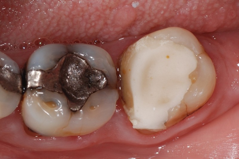 ganzheitliche Zahnheilkunde Dr. Heike Kretschmar - Zerstörungsgrad