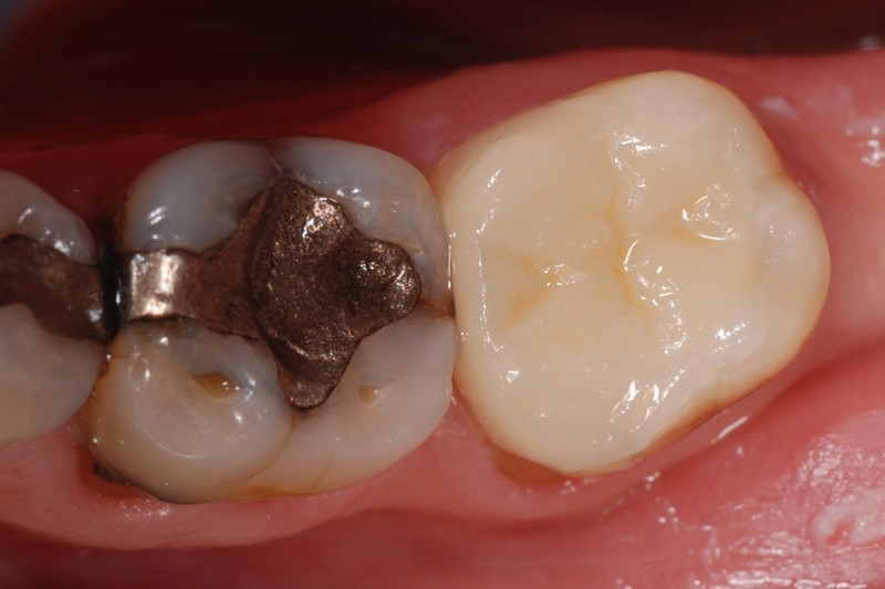 ganzheitliche Zahnheilkunde Dr. Heike Kretschmar - Zustand nach Versorgung