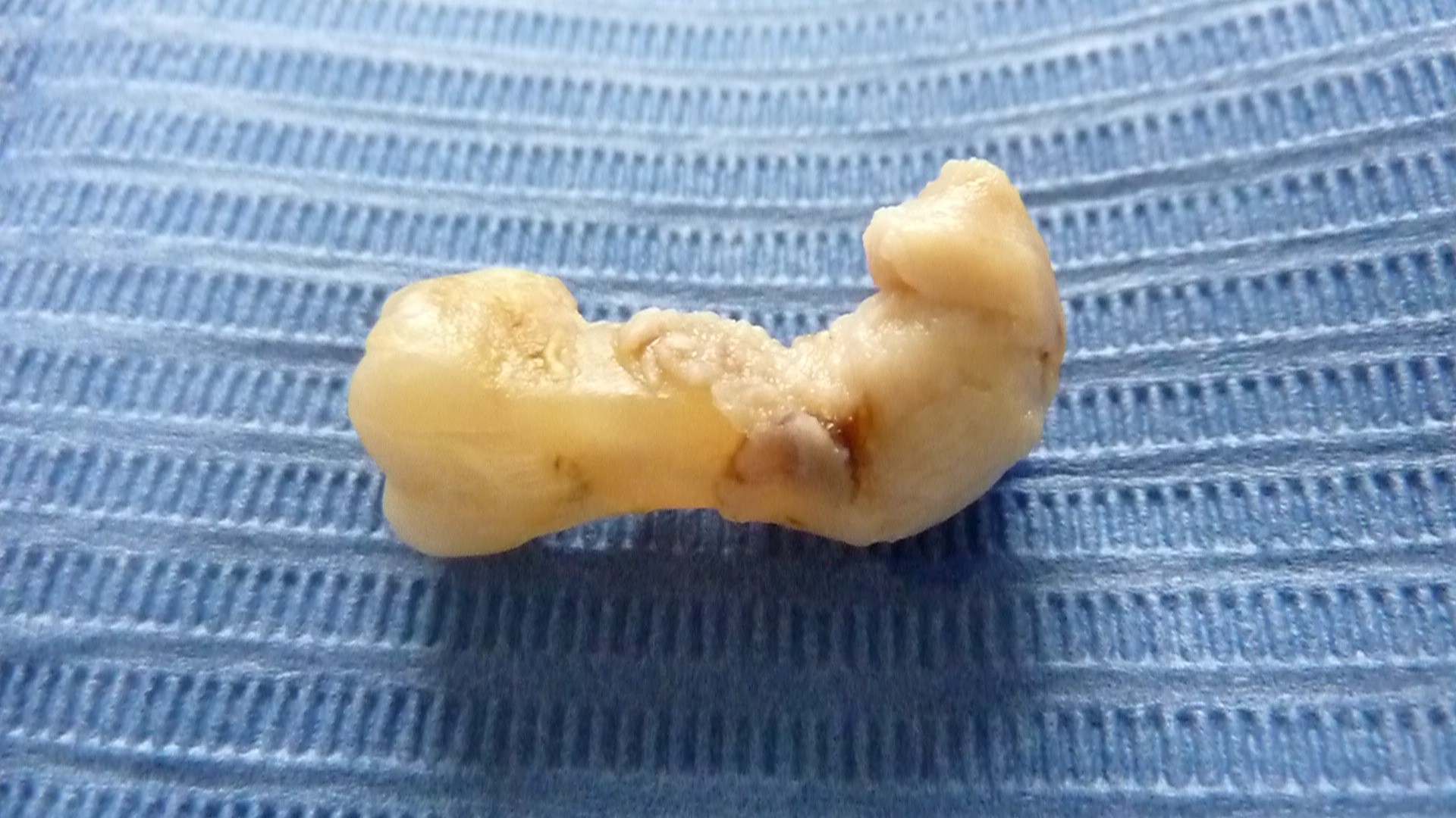 ganzheitliche Zahnheilkunde Dr. Heike Kretschmar - Toter Zahn mit Granulom